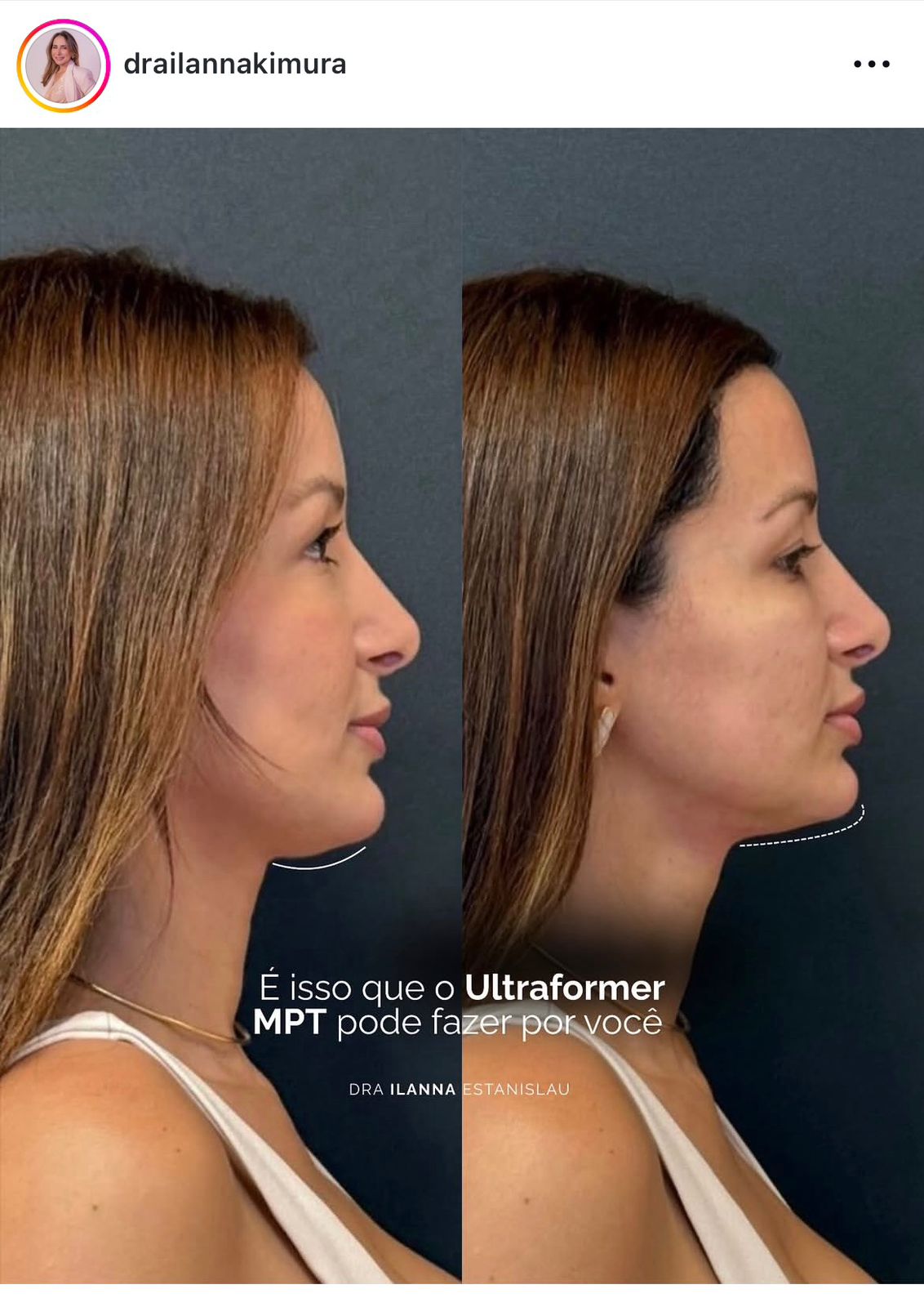 Resultado Botox