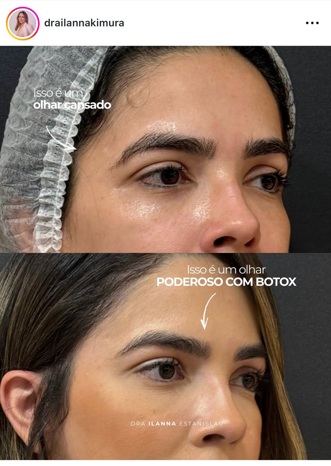 Resultado Botox