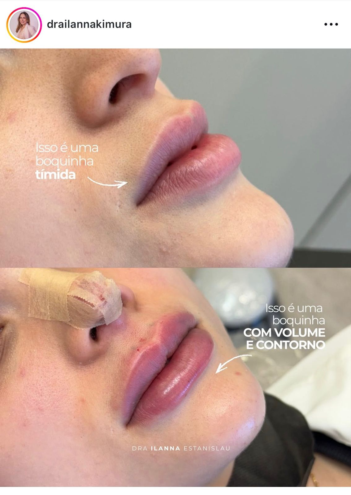 Preenchimento Labial